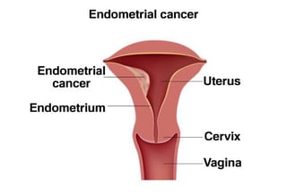 Endometrial Cancer: Risk Factors, Warning Signs, and Treatment