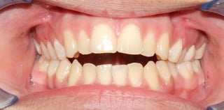 Anterior_Open_Bite.jpg