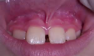 Frenum_pull-1