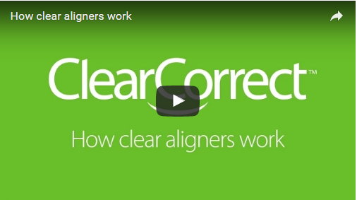 How clear aligners work.png