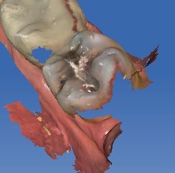 missing gingival CEREC.jpg