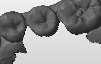 missing gingival carestream 2.jpg