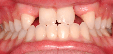 missing teeth.png