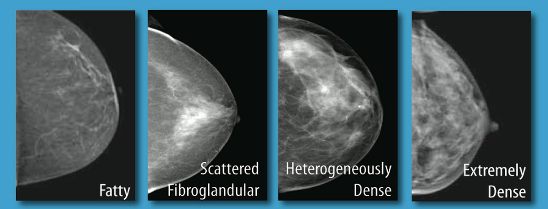 Imaging Breast Density