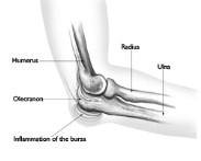 Olecranon Bursitis Olecranon Bursitis