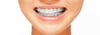 6 problemas dentales que solucionan los brackets estéticos