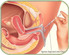 Preventing Sperm From Entering The Uterus