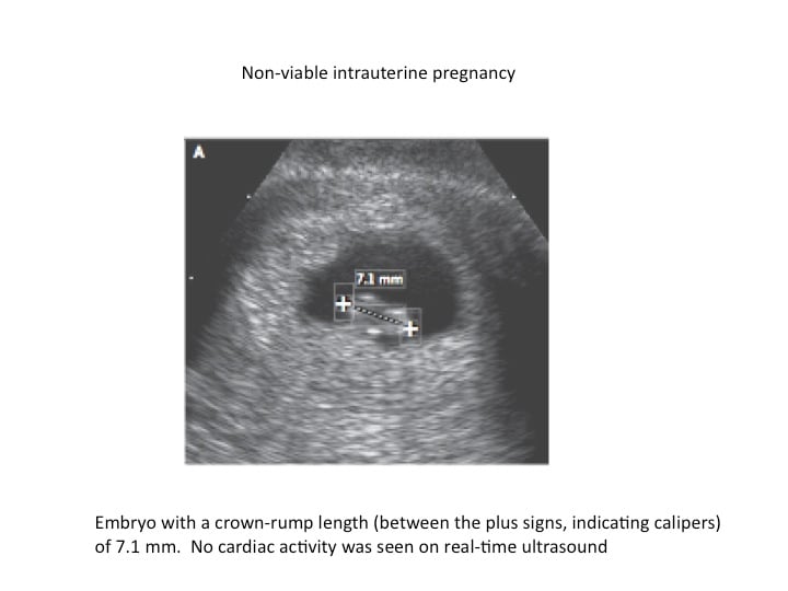 Heartbeat pregnant no Healthboards
