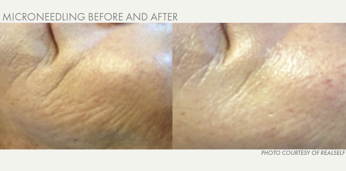 Microneedling before and after | Supriya Tomar MD