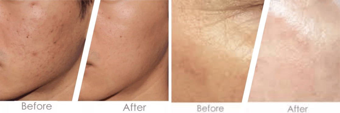 Microneedling before and after | Supriya Tomar MD