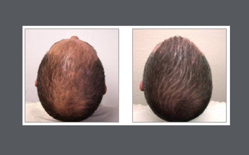 Houston Hair Restoration: The NeoGraft Procedure
