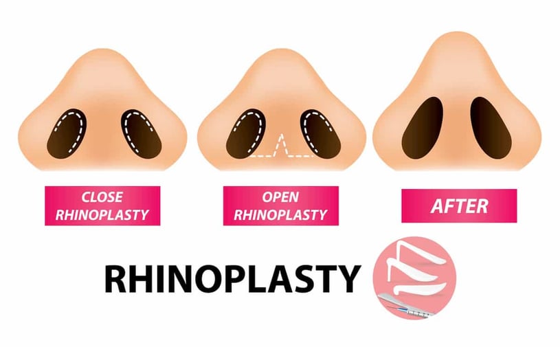 What to Look for in a Revision Rhinoplasty Specialist Near You