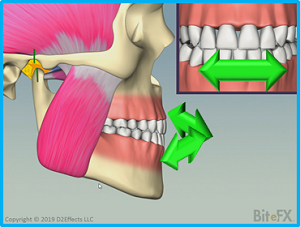 Knife-Edge-Anterior-Wear-with-Arrows-300x227