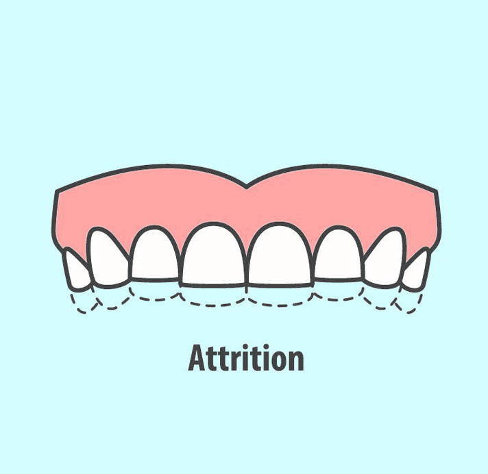 What Is Dental Attrition