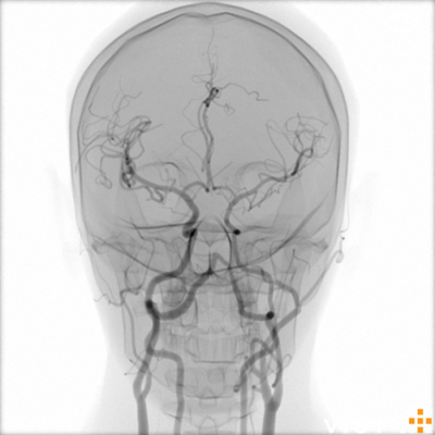 Mentice module Acute Stroke Intervention - Case-it