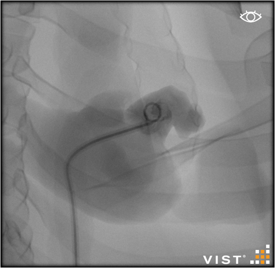 left Atrial Appendage Occlusion