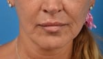 How a Lip Lift Can Counteract Aging Lips_After Photo