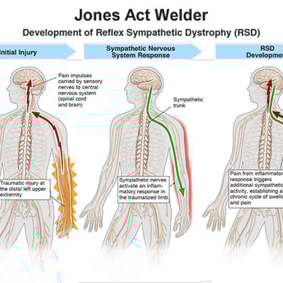 dredging-company-welder-lawsuit