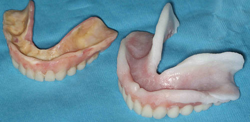 Dentures with Hydrocast