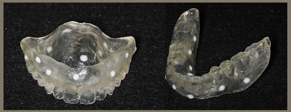 Dentures with Radiopaque Markers
