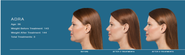 Is a Non-Surgical Facelift Possible?
