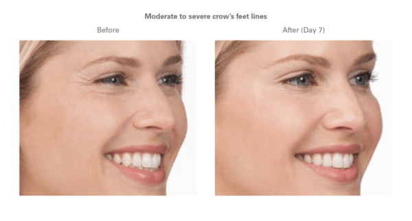 How Much Does Botox Cost? - Amerejuve Medspa in Cedarpines Park thumbnail