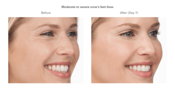 How Much Does Botox® Cost?
