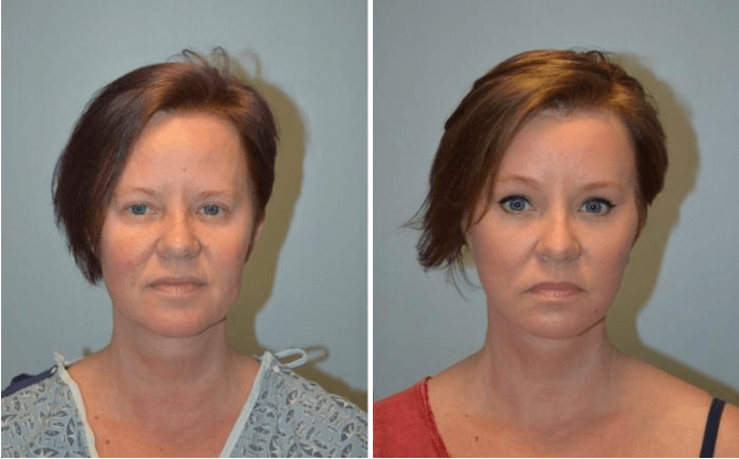How Much Does A Facelift Cost?