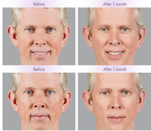 facial fillers & volumizers | before and after gallery | boston