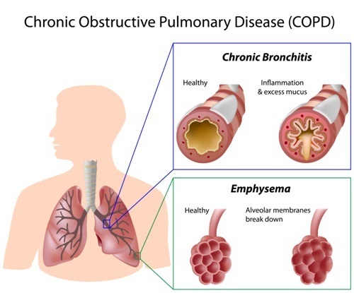 COPD inflammation.jpg