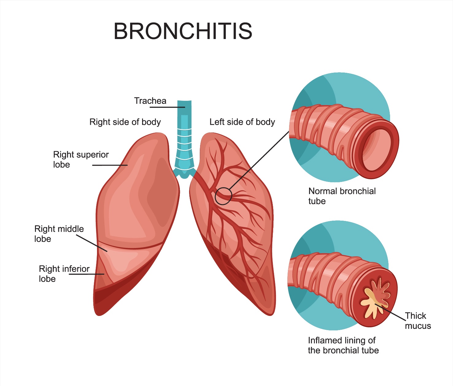 bronchitis.jpg