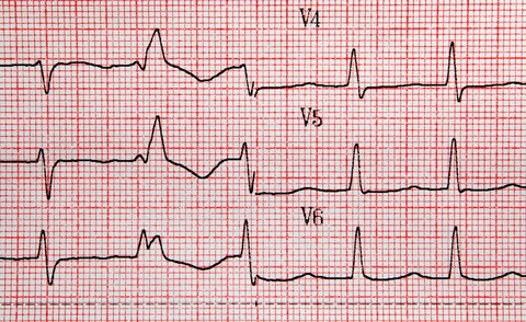 ekg results
