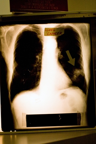 lung cancer in an x-ray
