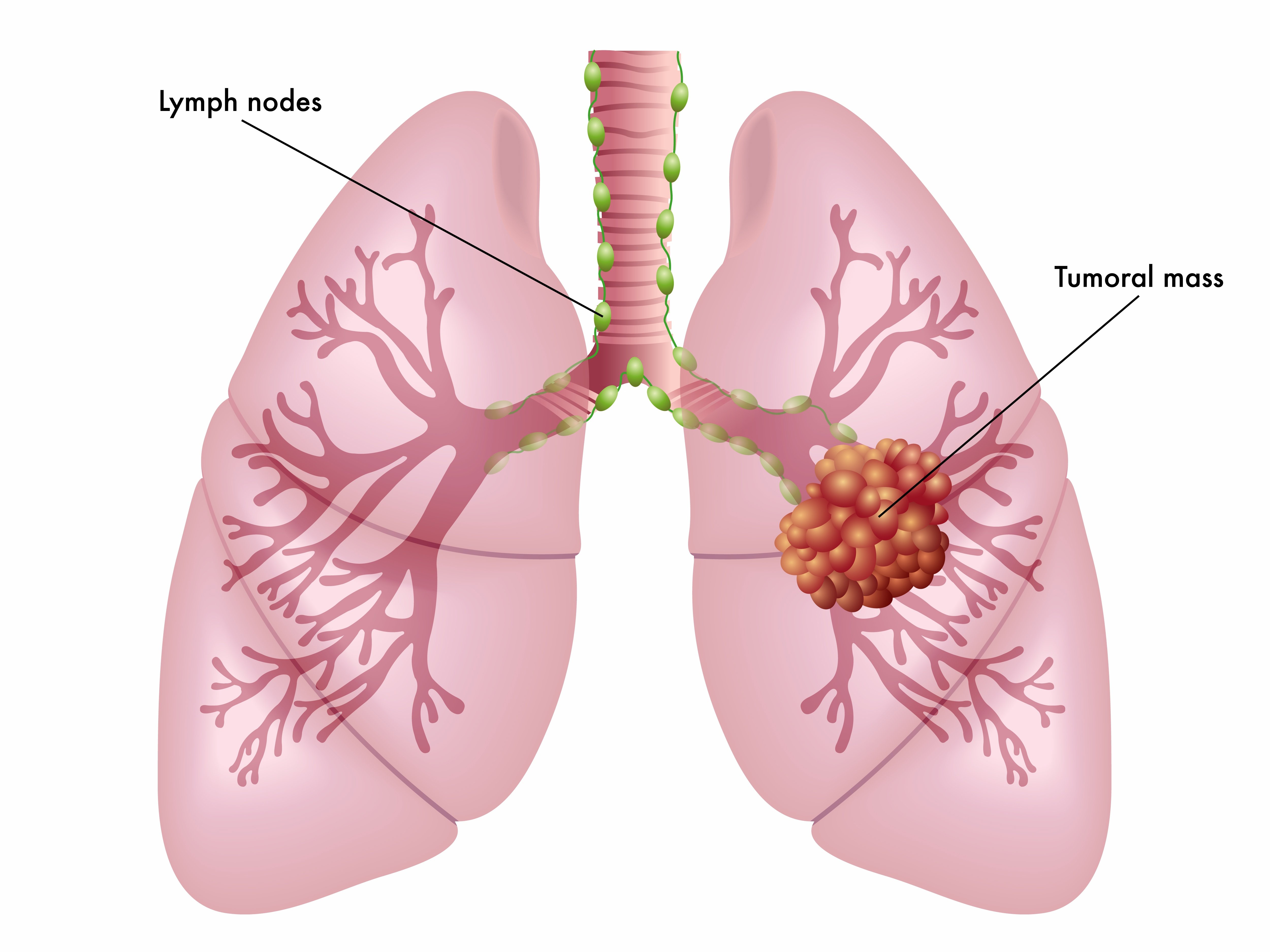 lung cancer