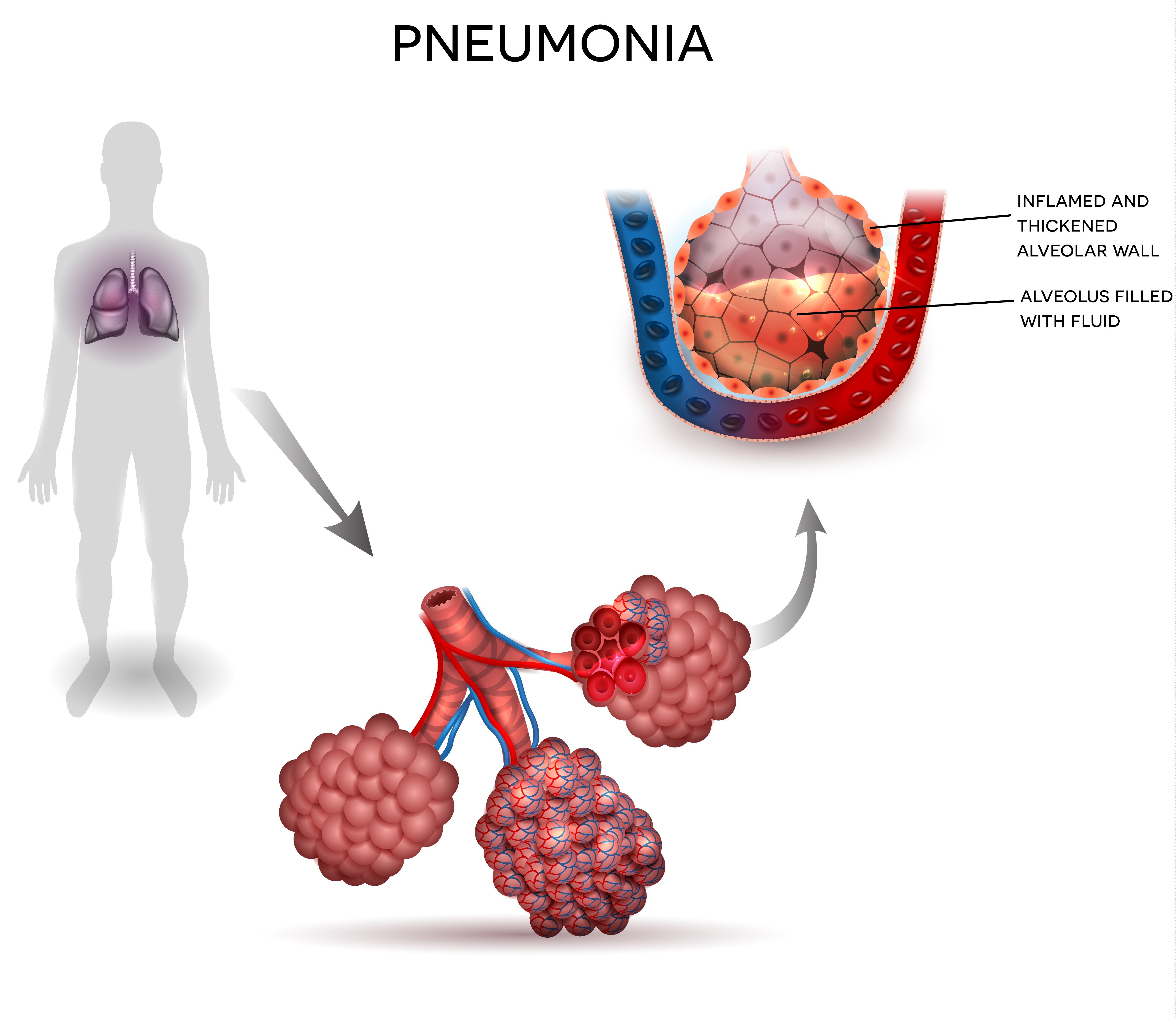 pneumonia