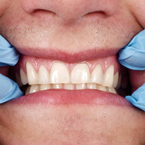 Oral Health and Aging: What to Know
