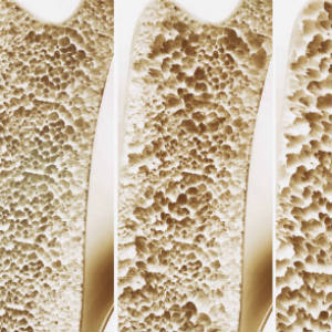 osteoporosis