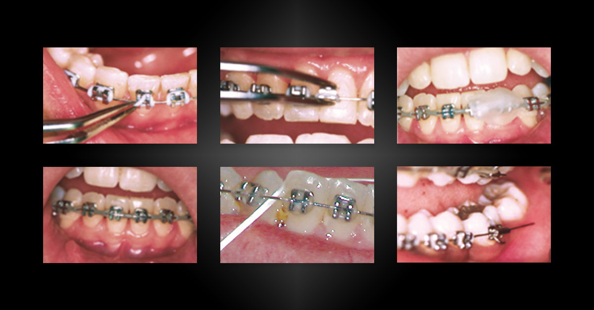 Orthodontic Emergencies - Boss Orthodontics