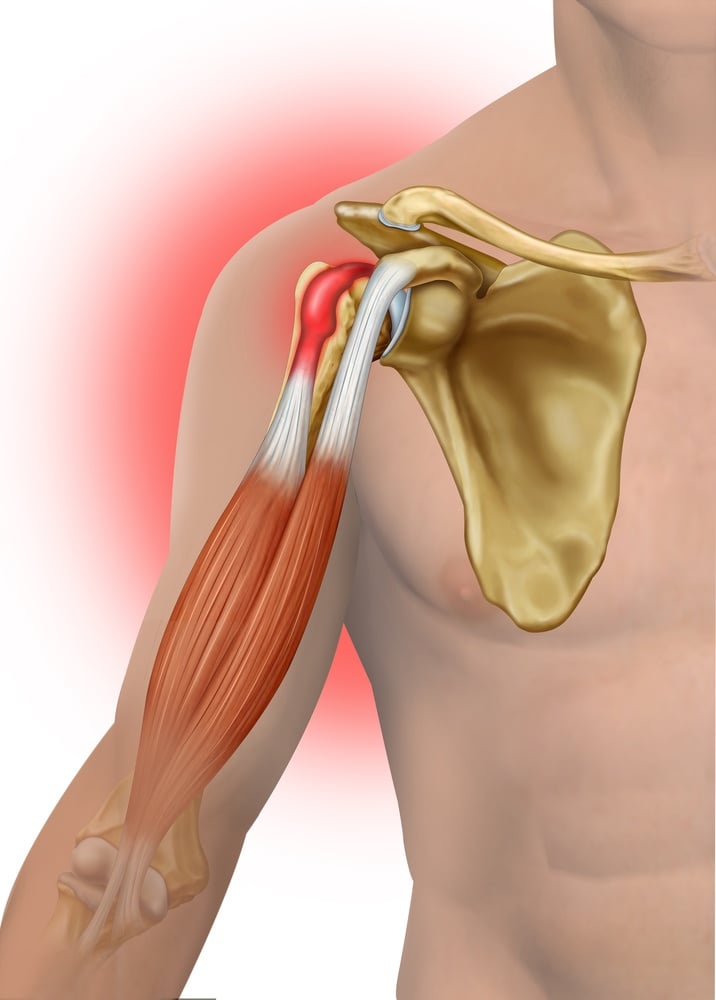 inflamed shoulder tendons