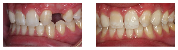 Dental Implants Before & After