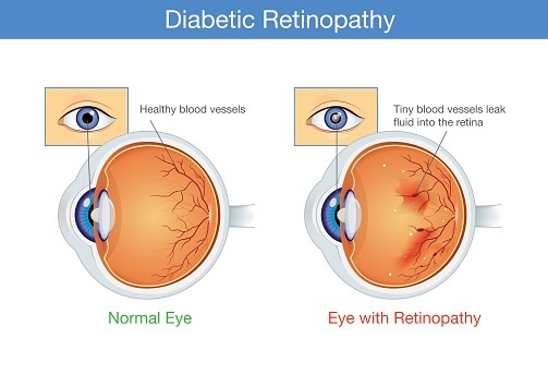 Eye Diseases: What is Diabetic Retinopathy?