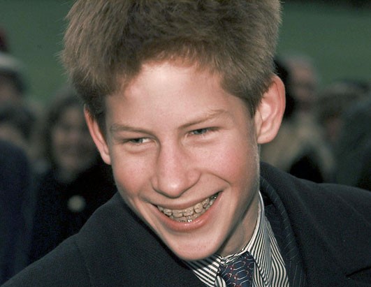 Prince Harry in braces