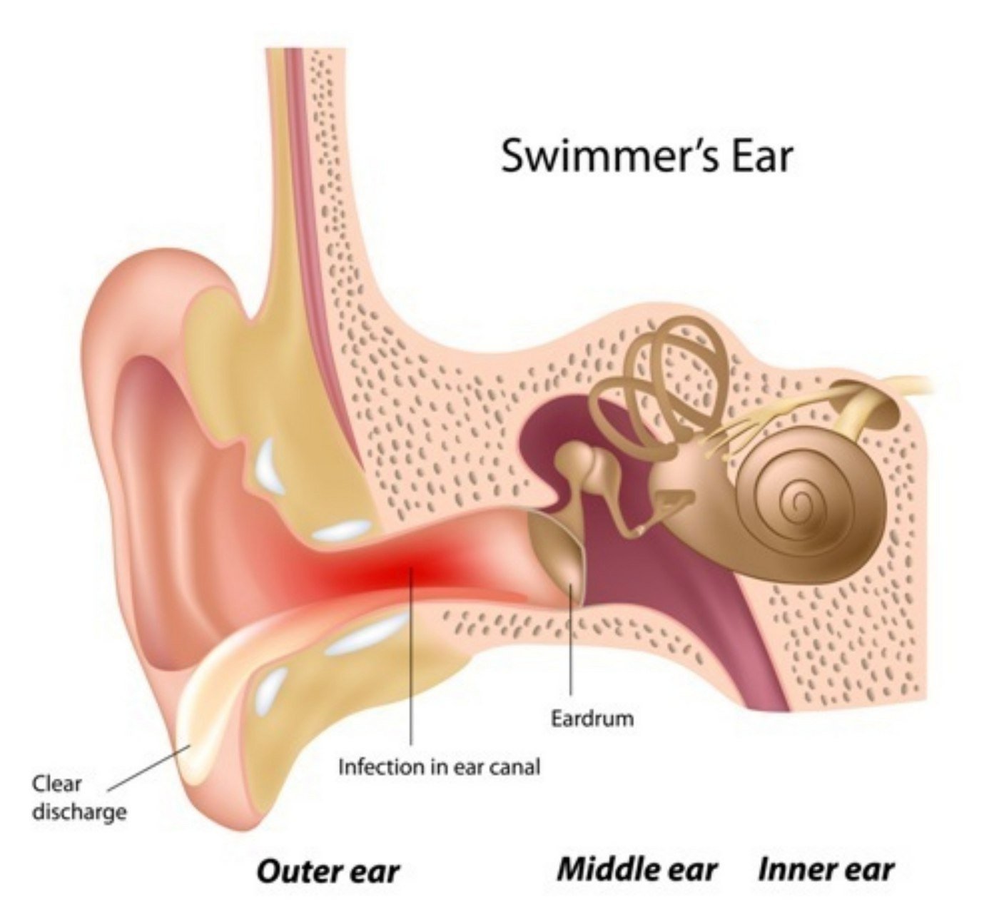 Swimmer's Ear Can Lead To Temporary Hearing Loss