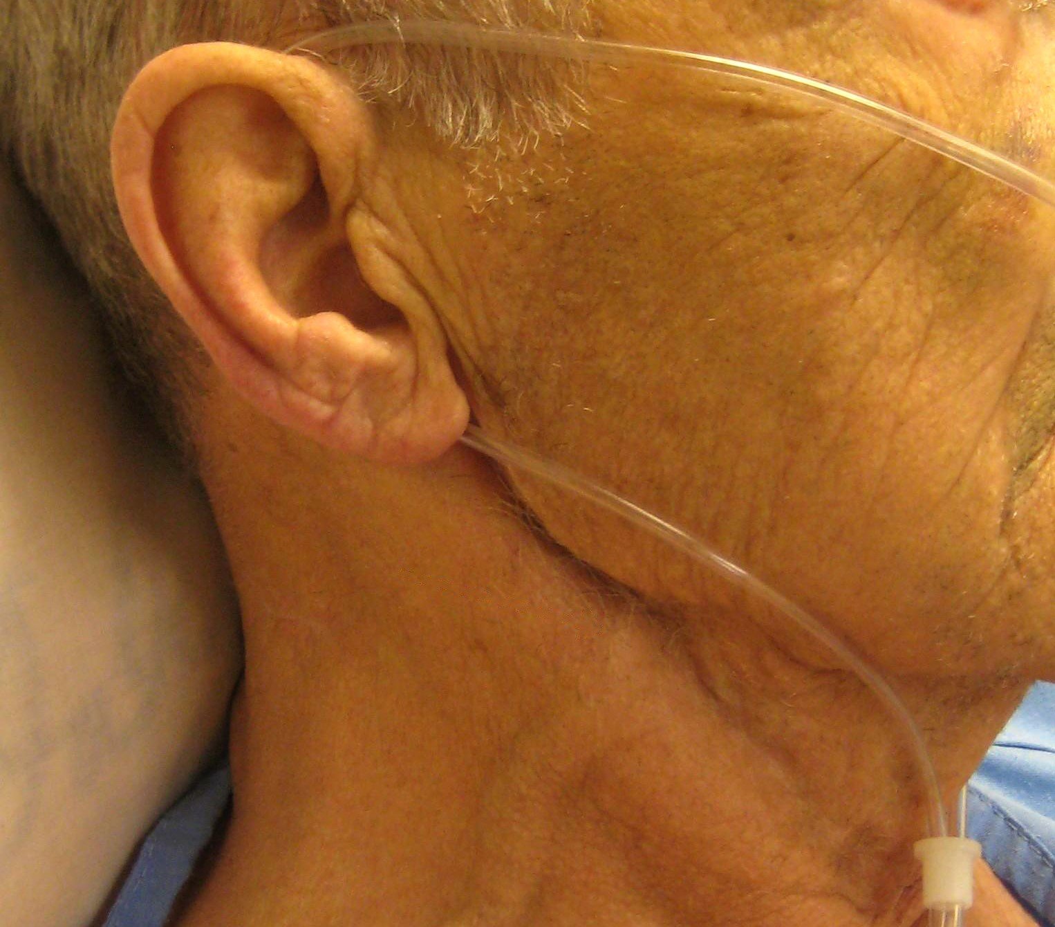 Cannula tube around a man's ear.