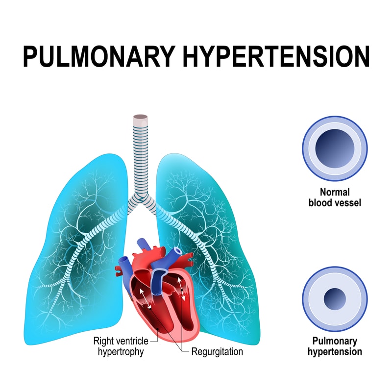 Diagram showing the effects of pulmonary hypertension.