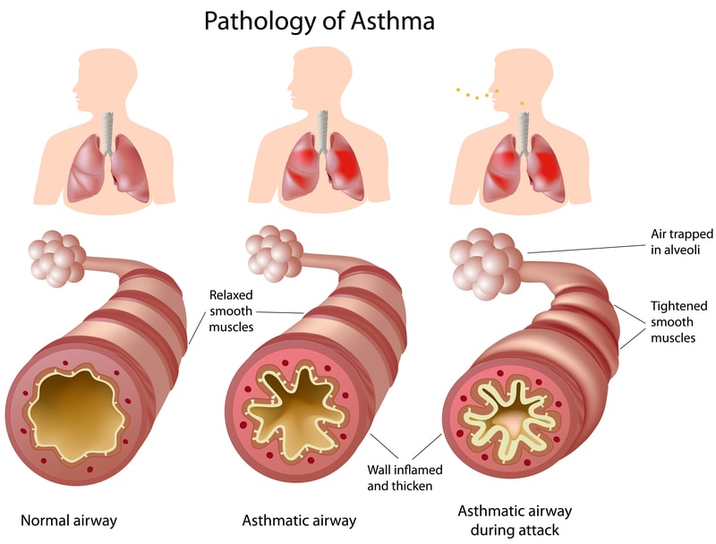 Diagram showing the effects of asthma and asthma attacks.