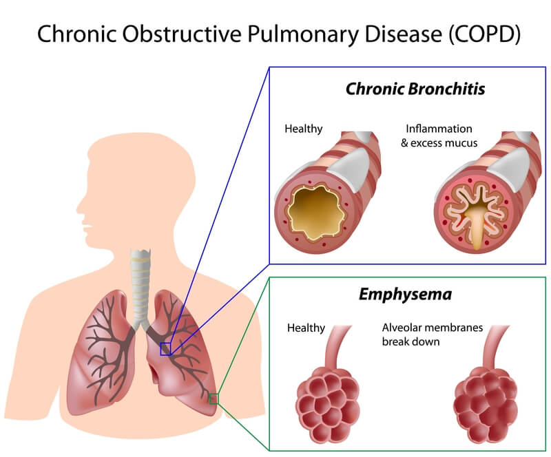 Diagram showing the difference between emphysema and chronic bronchitis.