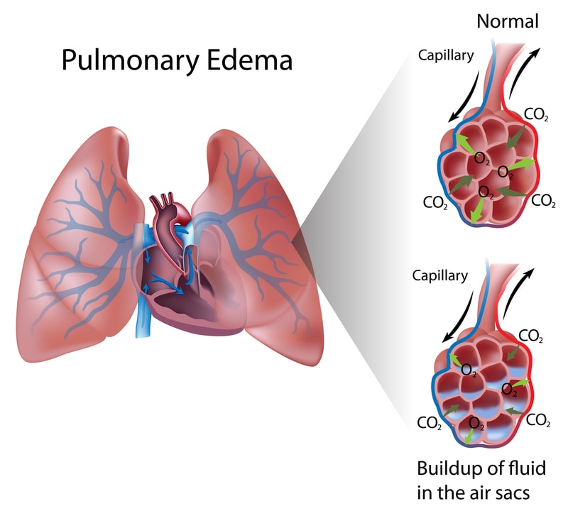 Diagram showing the effects of pulmonary edema.