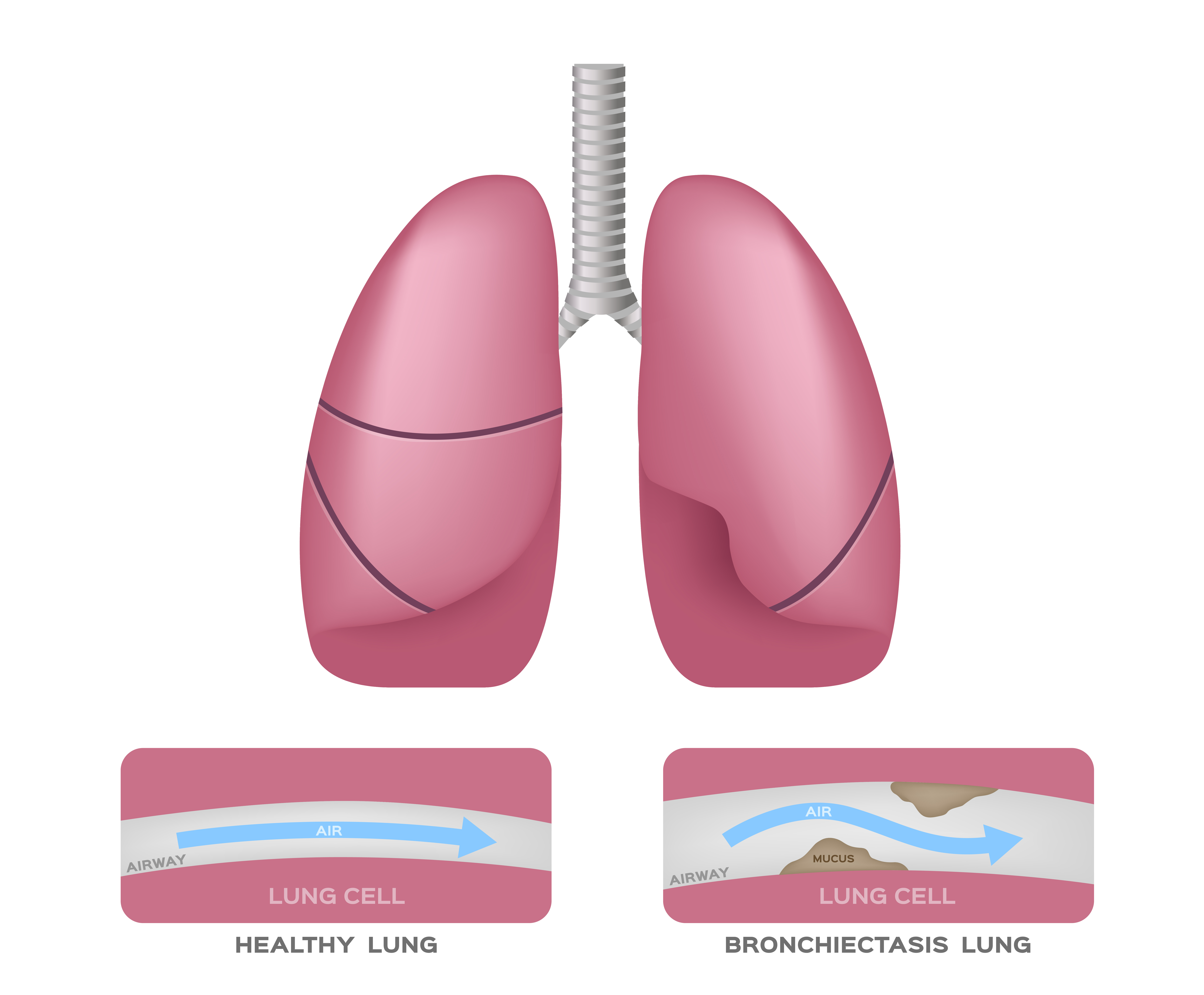 Bronchiectasis in the lungs