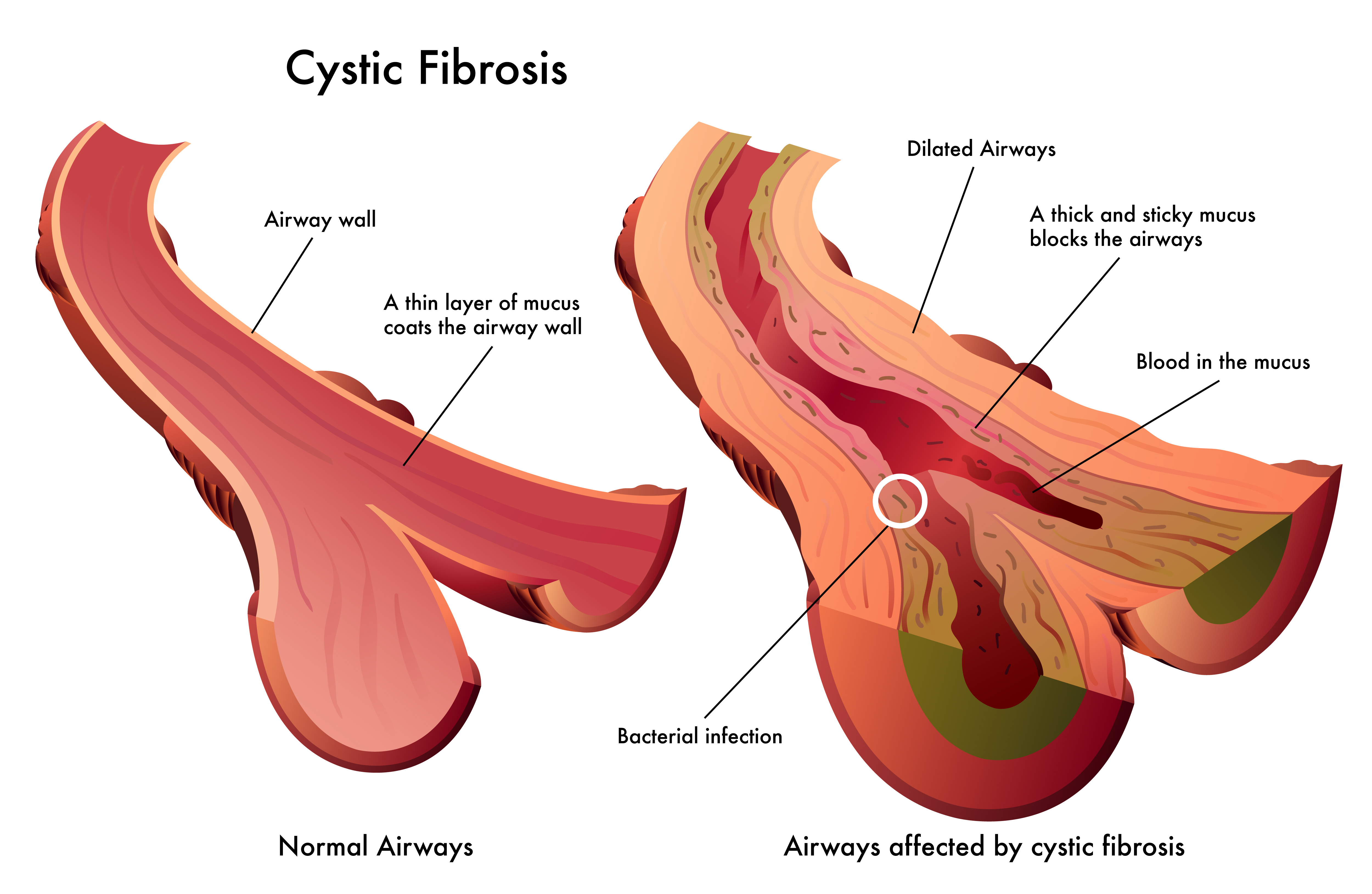 Cystic fibrosis diagram